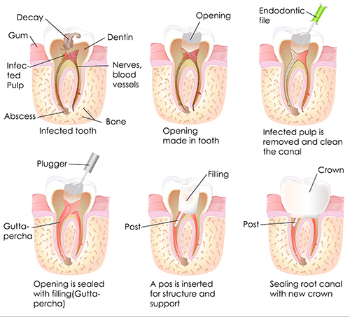 Root Canal Therapy in Andersonville